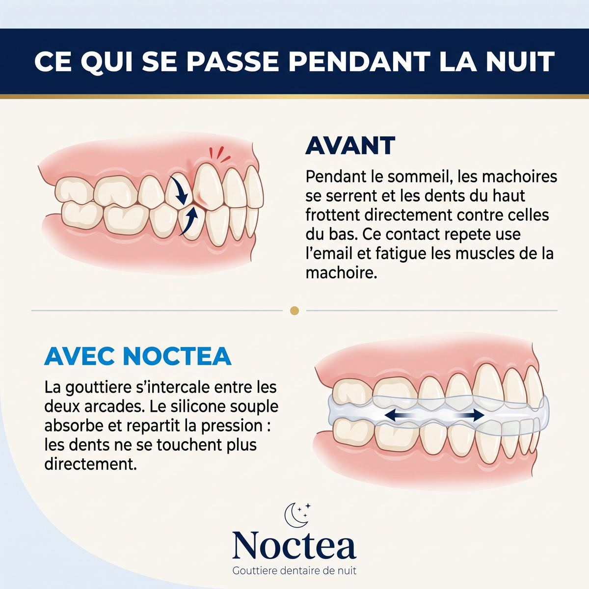 Noctea® - Gouttière Anti-Ronflement